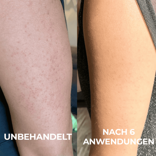 Fortschrittlicher Triple-Säuren-Komplex gegen Reibeisenhaut