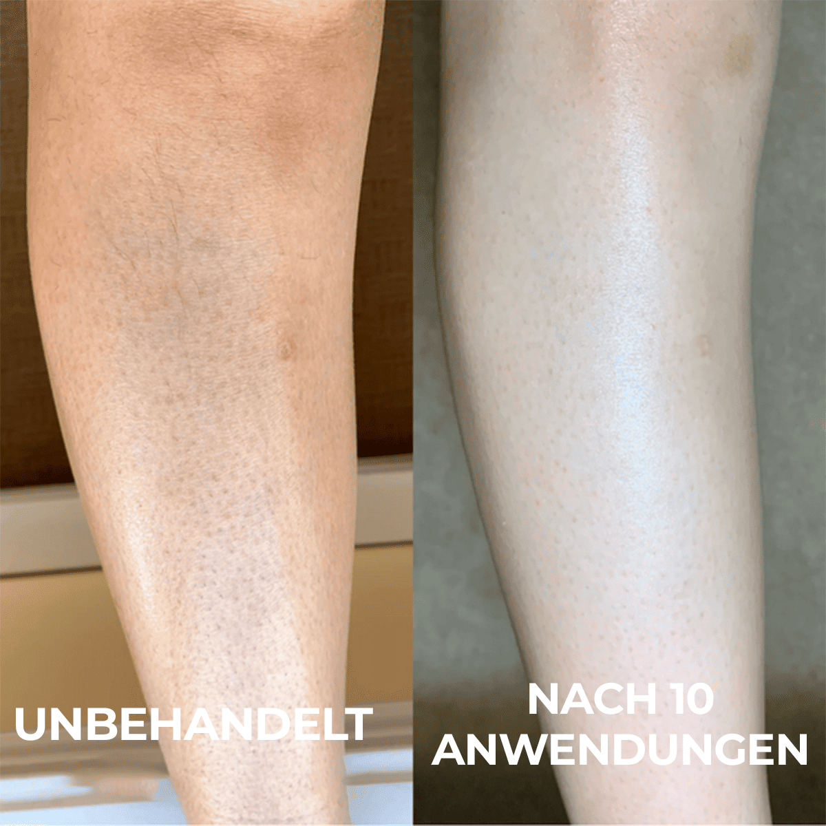 Fortschrittlicher Triple-Säuren-Komplex gegen Reibeisenhaut