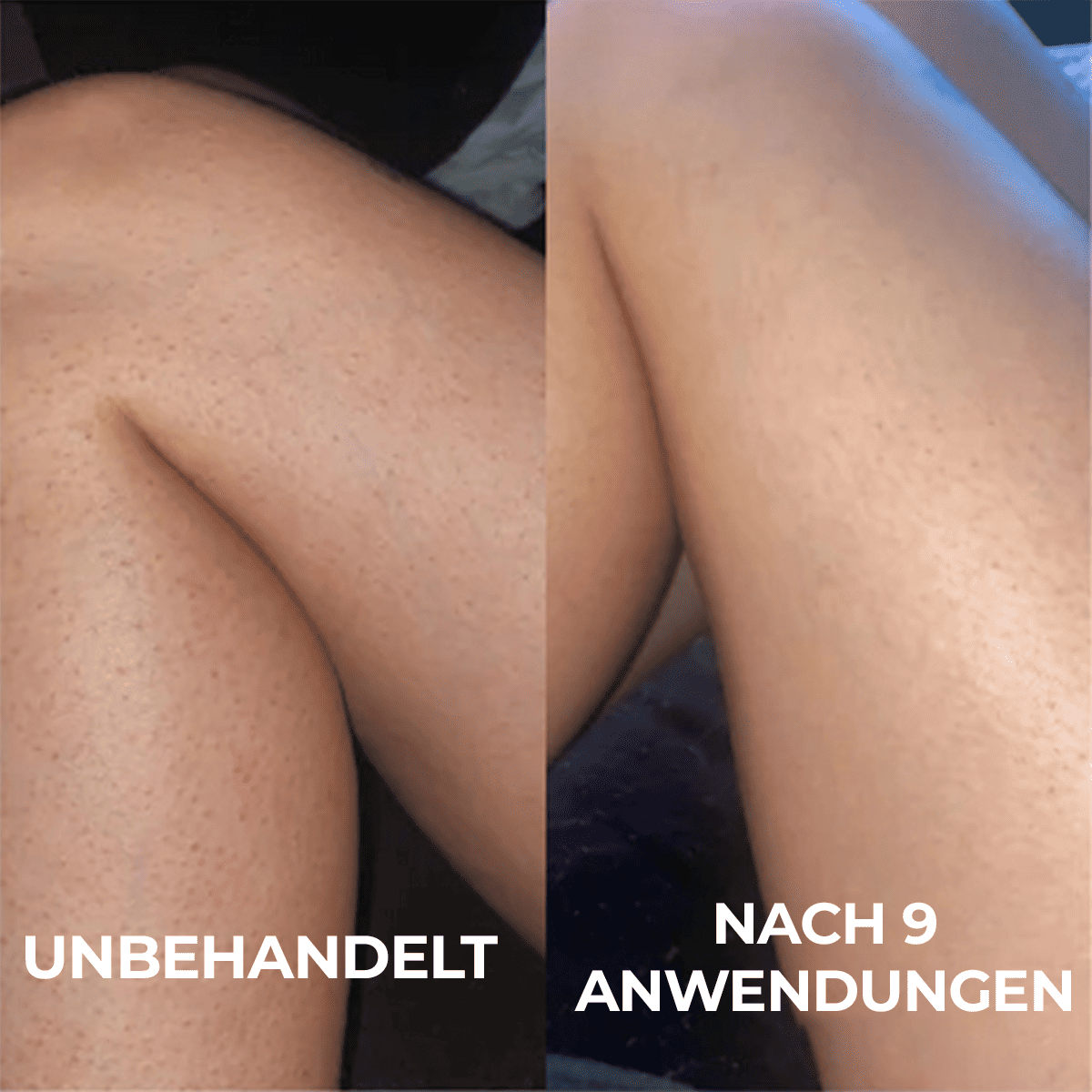 Fortschrittlicher Triple-Säuren-Komplex gegen Reibeisenhaut